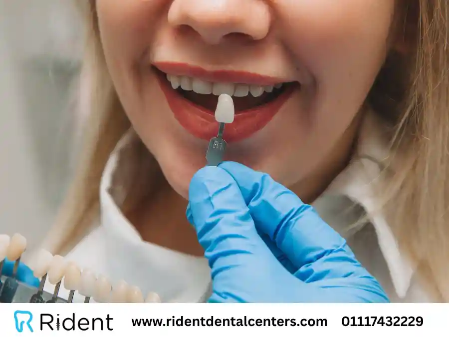 علاج تسوس الاسنان الامامية بالحشو والفينير في 4 خطوات